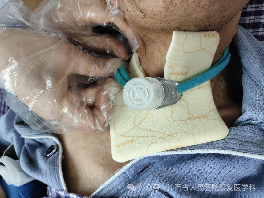 敷料芯怎么用【知识共享】气管切开患者的气道护理_https://www.jmylbn.com_新闻资讯_第8张