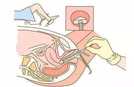 妇科荧光检查是什么科普丨揭开阴道镜的神秘面纱_https://www.jmylbn.com_新闻资讯_第4张
