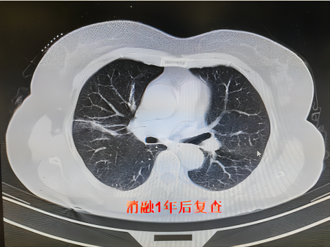 氦氩刀是什么【航医说医】“冻死”肿瘤--氩氦刀冷冻消融技术，肿瘤治疗新选择_https://www.jmylbn.com_新闻资讯_第9张