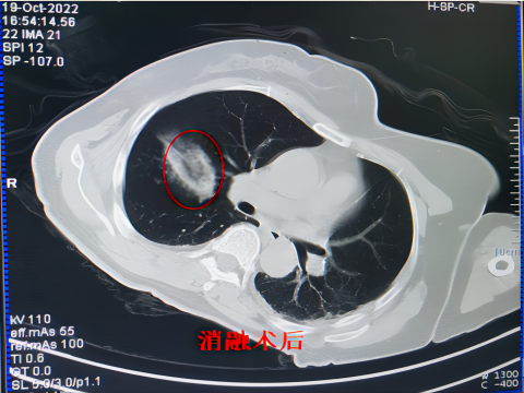 氦氩刀是什么【航医说医】“冻死”肿瘤--氩氦刀冷冻消融技术，肿瘤治疗新选择_https://www.jmylbn.com_新闻资讯_第8张