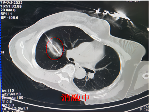 氦氩刀是什么【航医说医】“冻死”肿瘤--氩氦刀冷冻消融技术，肿瘤治疗新选择_https://www.jmylbn.com_新闻资讯_第7张