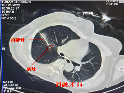 氦氩刀是什么【航医说医】“冻死”肿瘤--氩氦刀冷冻消融技术，肿瘤治疗新选择_https://www.jmylbn.com_新闻资讯_第6张