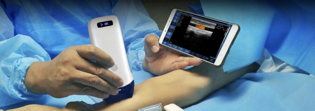 索诺星超声怎么样领跑全球的微型无线探头式掌上超声_https://www.jmylbn.com_新闻资讯_第8张