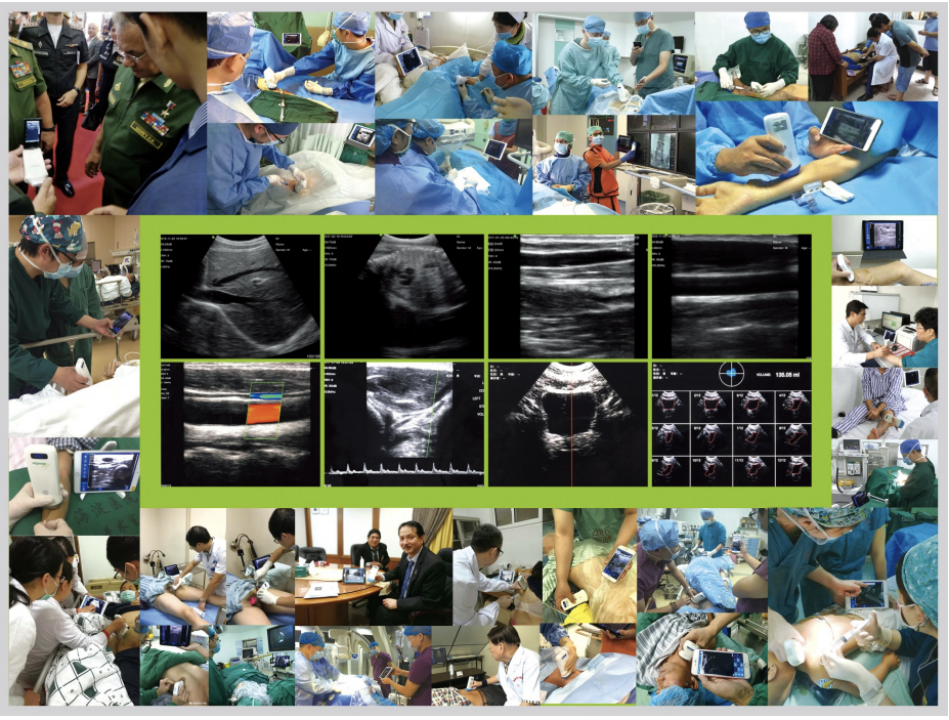 索诺星超声怎么样领跑全球的微型无线探头式掌上超声_https://www.jmylbn.com_新闻资讯_第11张