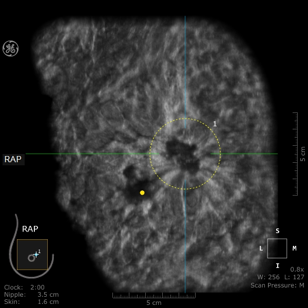 什么是超声容积探头乳腺超声诊断有“神器”——自动乳腺全容积超声成像_https://www.jmylbn.com_新闻资讯_第5张