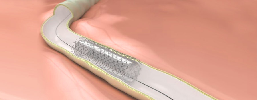 乐普心脏支架怎么样行业研究｜一文了解冠脉支架的前世今生_https://www.jmylbn.com_新闻资讯_第2张