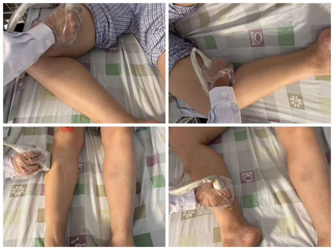 esaote彩超怎么用久站久坐族，请警惕下肢深静脉血栓_https://www.jmylbn.com_新闻资讯_第10张