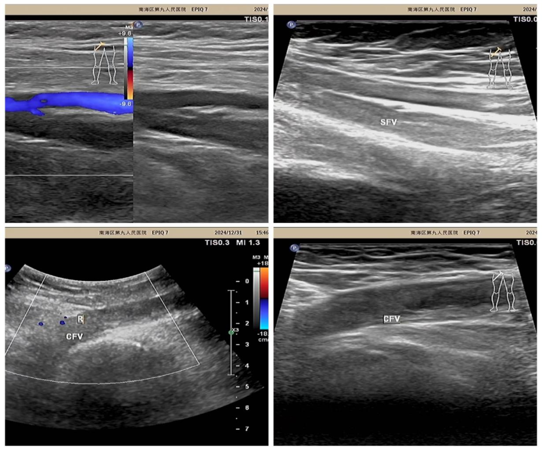 esaote彩超怎么用久站久坐族，请警惕下肢深静脉血栓_https://www.jmylbn.com_新闻资讯_第4张