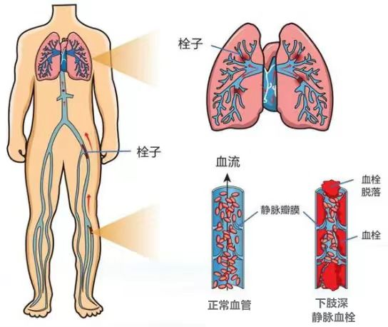 esaote彩超怎么用久站久坐族，请警惕下肢深静脉血栓_https://www.jmylbn.com_新闻资讯_第7张