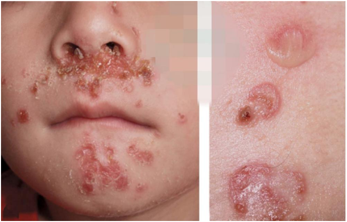 疱疮不是普通痘痘,出现这些症状要警惕!