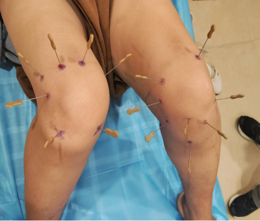 針刀聯(lián)合臭氧治療-疼痛康復(fù)的新選擇