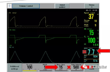 呼吸机呼气阀是什么医工实习：呼吸机的常用模式及故障_https://www.jmylbn.com_新闻资讯_第6张
