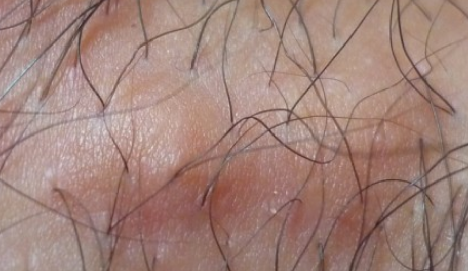 男人阴处毛囊炎症状解析：红肿、疼痛、瘙痒如何应对？