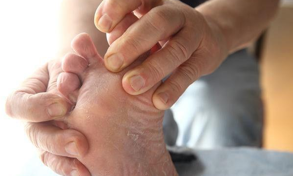 水疱型手足癣怎么办？