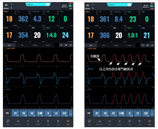 呼吸机ac是什么意思【收藏】有创呼吸机PCV模式详细解读！_https://www.jmylbn.com_新闻资讯_第2张