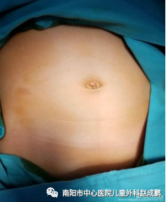 vsd引流器怎么连接创面负压封闭引流技术（VSD），让患者创面更快痊愈！_https://www.jmylbn.com_新闻资讯_第6张