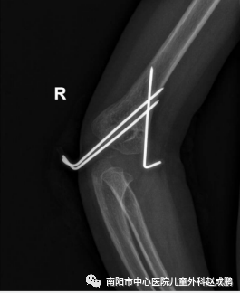 vsd引流器怎么连接创面负压封闭引流技术（VSD），让患者创面更快痊愈！_https://www.jmylbn.com_新闻资讯_第11张
