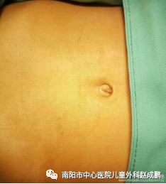 vsd引流器怎么连接创面负压封闭引流技术（VSD），让患者创面更快痊愈！_https://www.jmylbn.com_新闻资讯_第4张