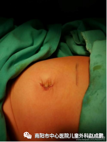 vsd引流器怎么连接创面负压封闭引流技术（VSD），让患者创面更快痊愈！_https://www.jmylbn.com_新闻资讯_第9张