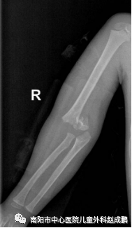 vsd引流器怎么连接创面负压封闭引流技术（VSD），让患者创面更快痊愈！_https://www.jmylbn.com_新闻资讯_第10张