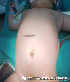 vsd引流器怎么连接创面负压封闭引流技术（VSD），让患者创面更快痊愈！_https://www.jmylbn.com_新闻资讯_第8张