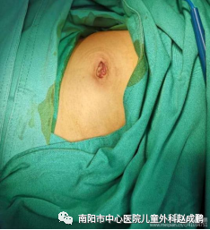 vsd引流器怎么连接创面负压封闭引流技术（VSD），让患者创面更快痊愈！_https://www.jmylbn.com_新闻资讯_第5张