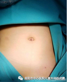 vsd引流器怎么连接创面负压封闭引流技术（VSD），让患者创面更快痊愈！_https://www.jmylbn.com_新闻资讯_第7张