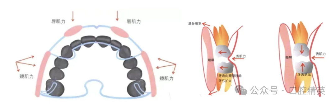 法兰克3矫治器使用方法
