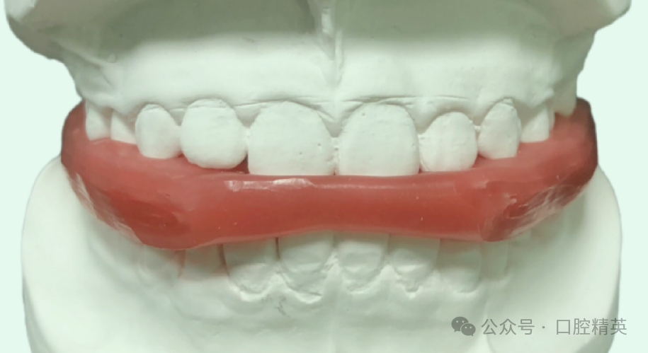 法兰克3矫治器使用方法