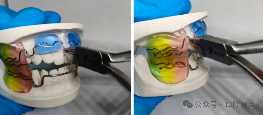 法兰克3矫治器使用方法