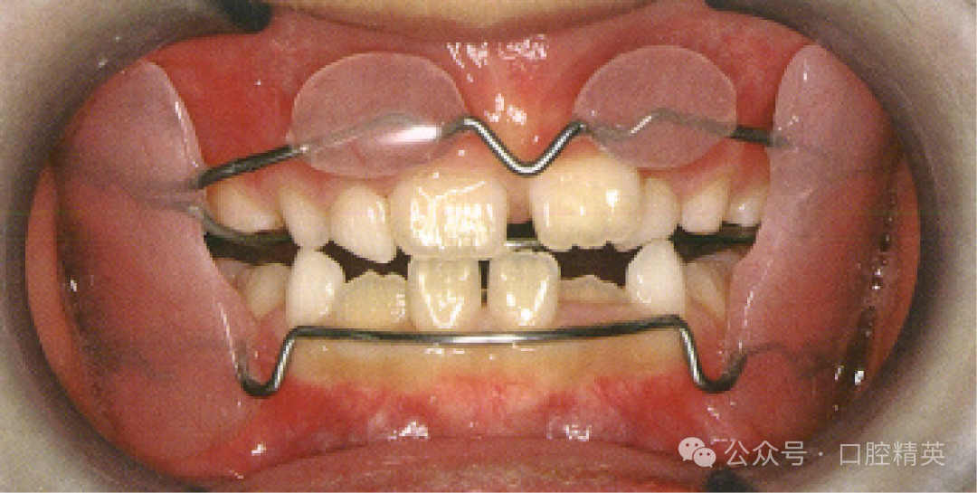 法兰克3矫治器使用方法