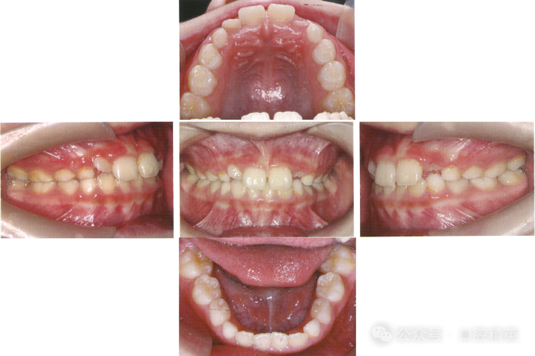 法兰克3矫治器使用方法