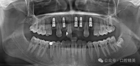 前牙即刻种植翻瓣好还是不翻瓣好？