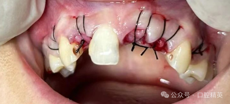 前牙即刻种植翻瓣好还是不翻瓣好？