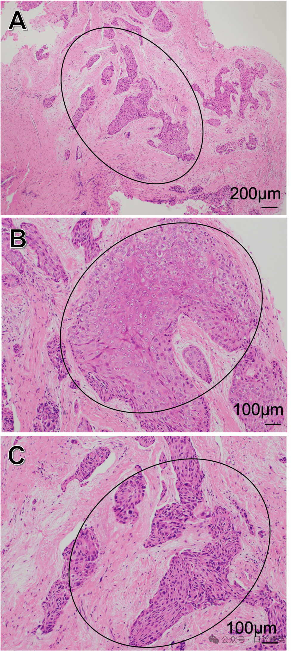 智齿也不要乱拔，可能是骨内癌