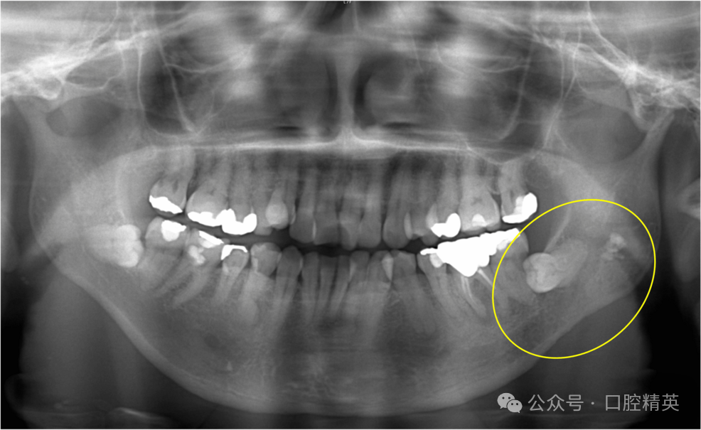 智齿也不要乱拔，可能是骨内癌