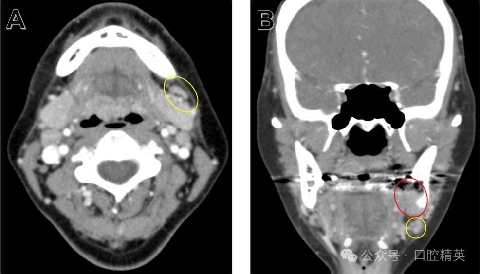 智齿也不要乱拔，可能是骨内癌