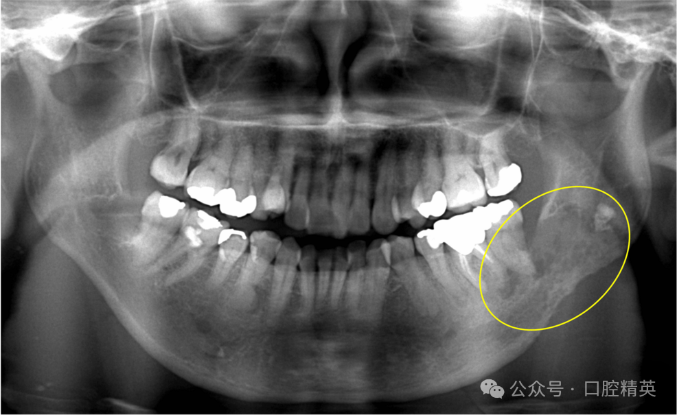 智齿也不要乱拔，可能是骨内癌