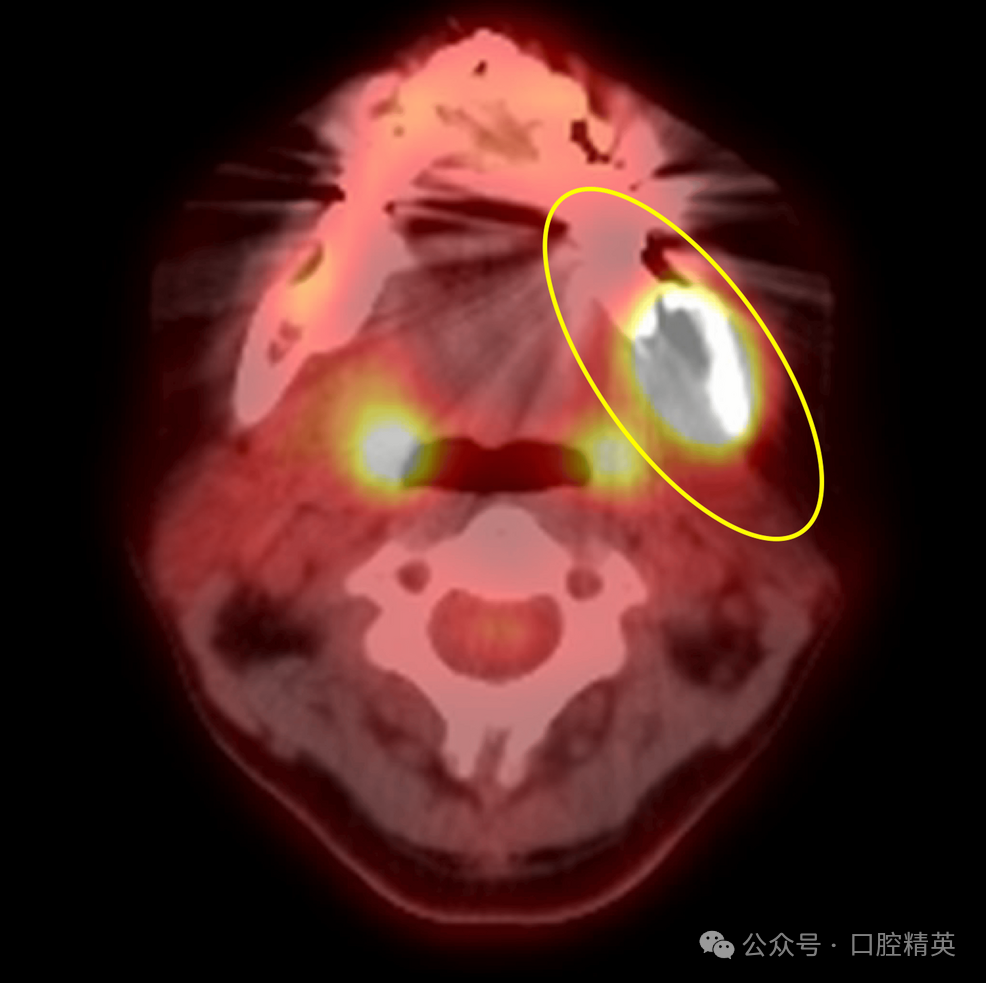智齿也不要乱拔，可能是骨内癌
