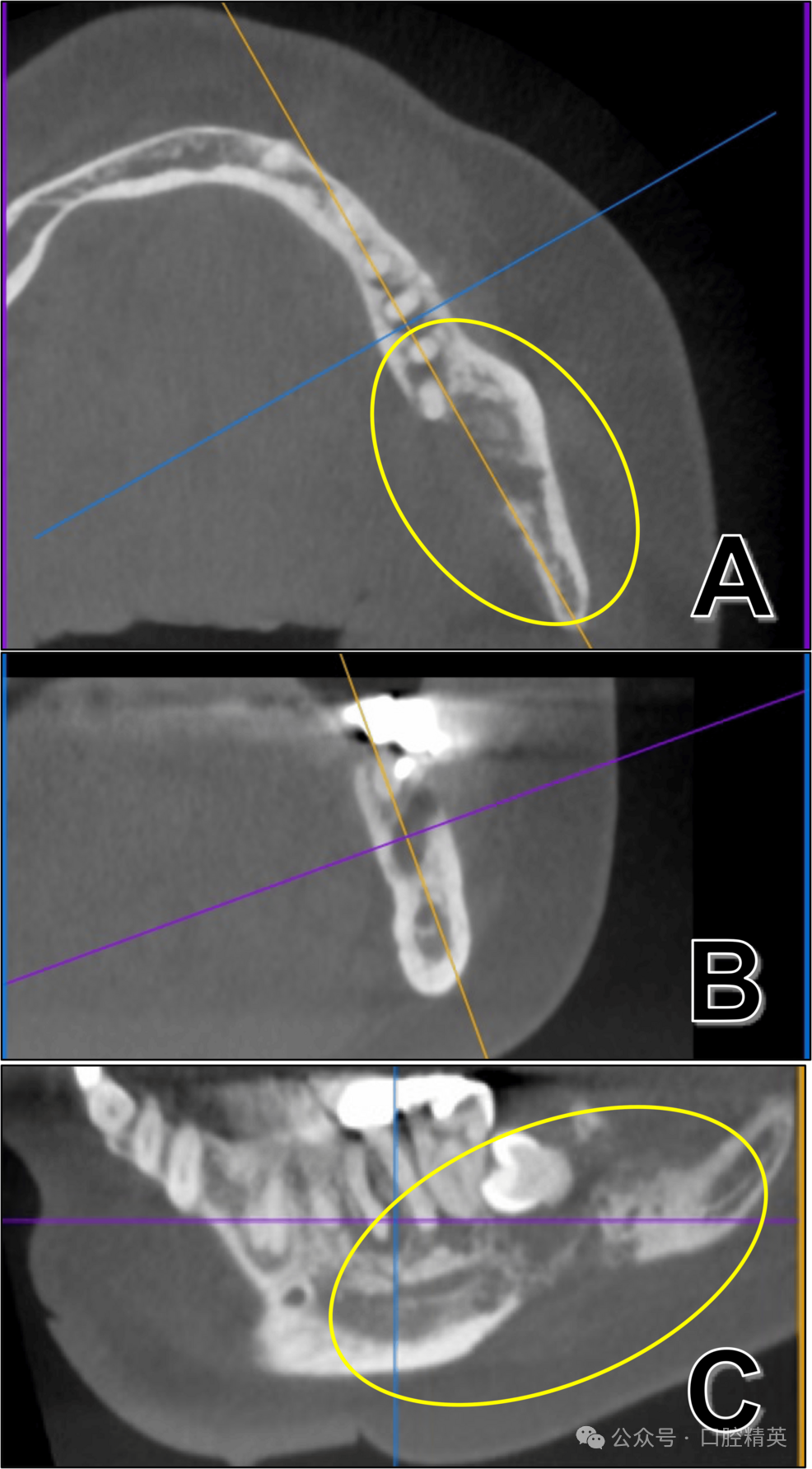 智齿也不要乱拔，可能是骨内癌