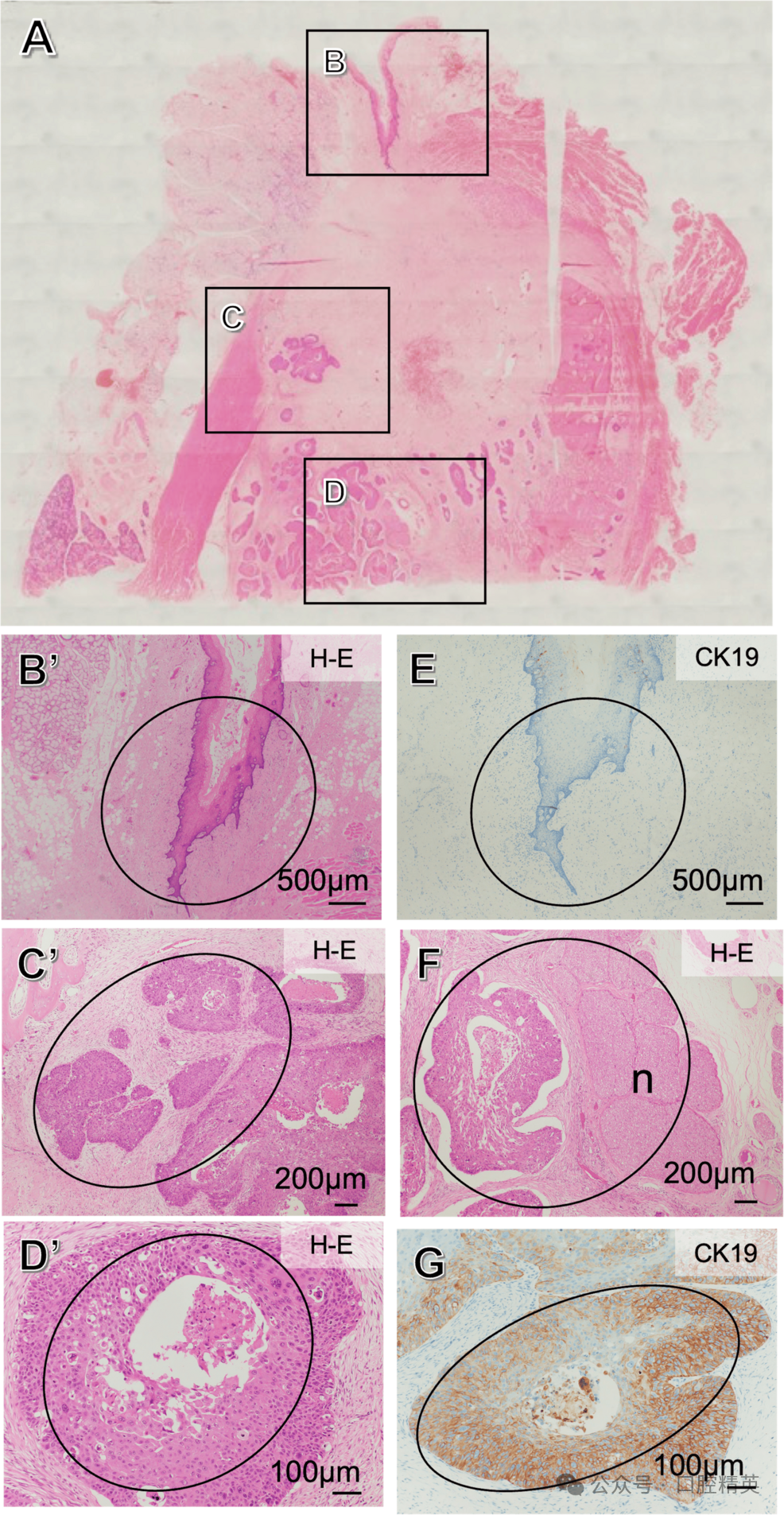 智齿也不要乱拔，可能是骨内癌