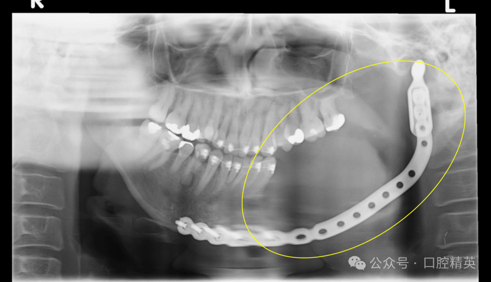 智齿也不要乱拔，可能是骨内癌
