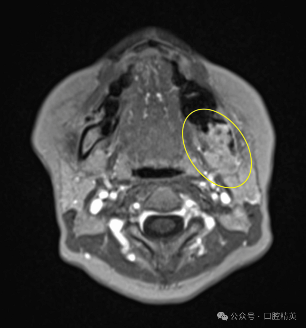 智齿也不要乱拔，可能是骨内癌