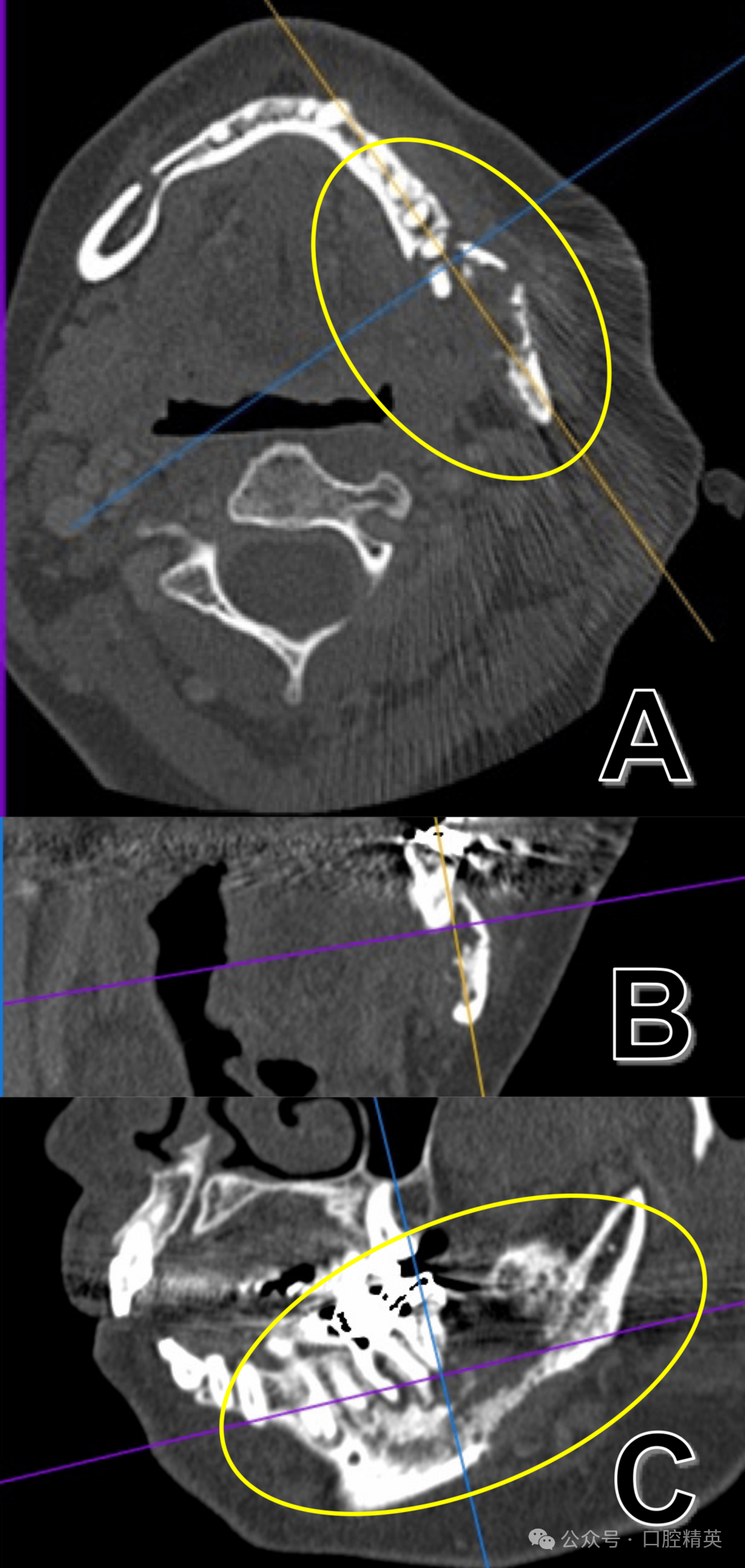 智齿也不要乱拔，可能是骨内癌