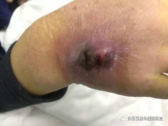 外科敷料是什么外科手术不能处理的感染，伤口专科护士用酒精+敷料治愈-上海聚慕医疗器械有限公司
