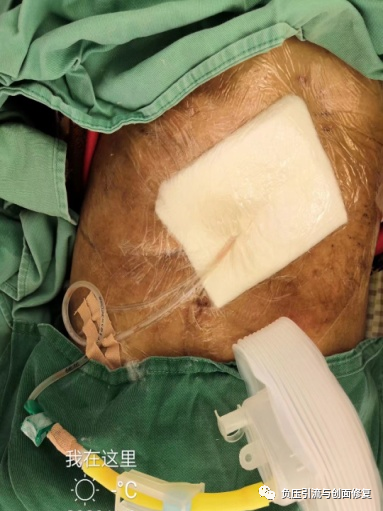 伤口负压治疗怎么收费致敬一名基层伤口专科护士，孤勇者里面的英雄，用纱布负压治愈胆漏_https://www.jmylbn.com_新闻资讯_第5张