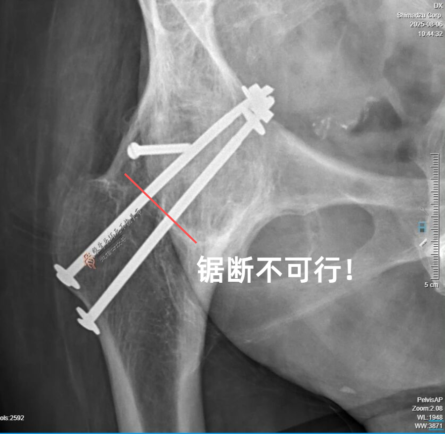 34张图文详解：21年融合髋THA的几点体会
