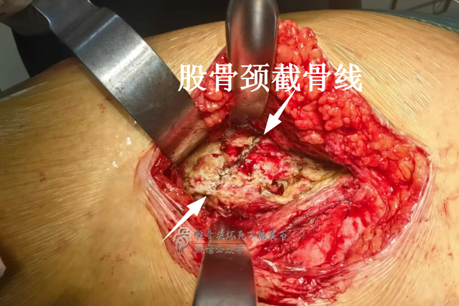 34张图文详解：21年融合髋THA的几点体会