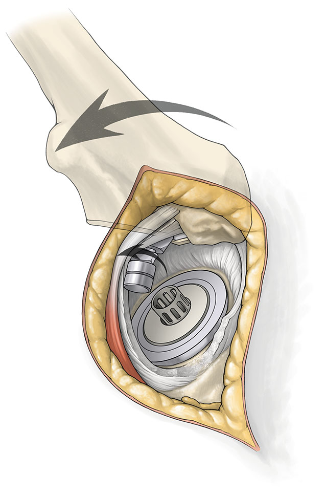 SuperPATH微创全髋关节置换手术入路图解