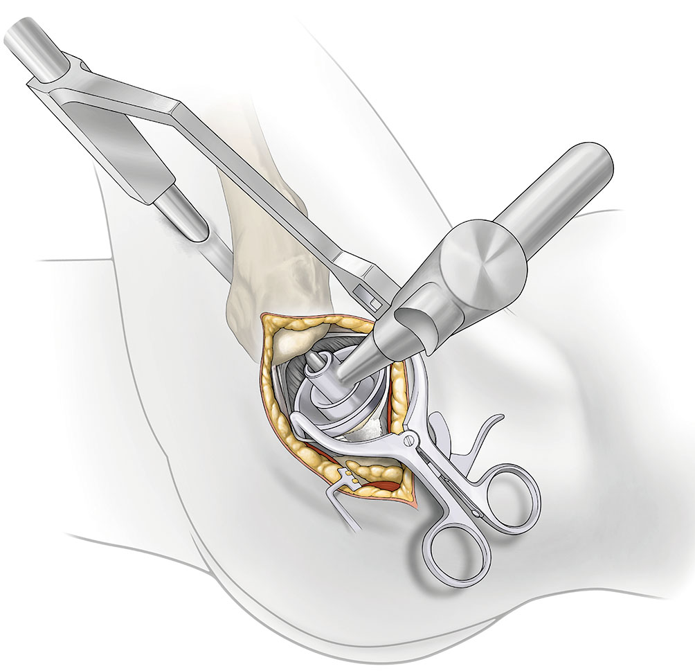 SuperPATH微创全髋关节置换手术入路图解